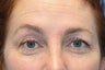 Browlift w hairline lowering, Upper eye blepharoplasty, Lower eyelid skin pinch, Fat transfer