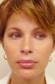 Lip Augmentation