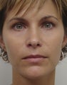 Lip Augmentation
