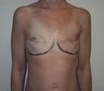 44 year old female patient 