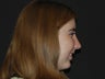 Chin Augmentation