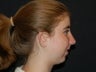 Chin Augmentation