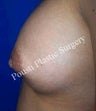 Nipple-Areola Repair