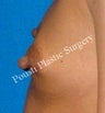 Nipple-Areola Repair