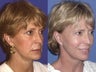 Facelift