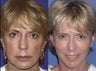 Facelift