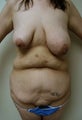 Body Lift