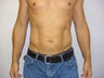 Liposuction
