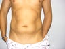 Liposuction