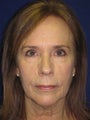 Facelift/Necklift combined with Facial Fat Grafting
