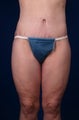 42 Year Old Weight Loss Patient 