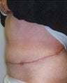 Female patient who underwent surgery for major weight loss 