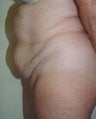 Female patient who underwent surgery for major weight loss 