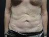Tummy Tuck