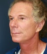 Facial Rejuvenation and Rhinoplasty, 64 yo male