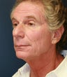 Facial Rejuvenation and Rhinoplasty, 64 yo male