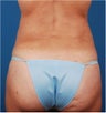 Vaser Liposuction
