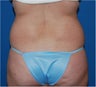 Vaser Liposuction