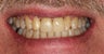 Implants with Crown Restorations