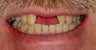 Implants with Crown Restorations
