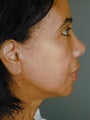 Female Chin Implant 