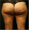 SmartLipo MPX