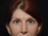 Eyelid Surgery