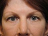 Eyelid Surgery