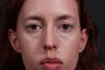 This patient had fat grafting performed to the eyelids, cheeks, and temples