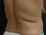 Coolsculpting