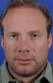 Revision Rhinoplasty