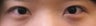 Asian Eyelid Surgery