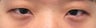 Asian Eyelid Surgery