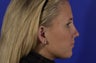 Rhinoplasty