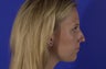 Rhinoplasty