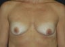 Breast Asymmetry