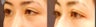 Droopy Eyelid or Ptosis Repair