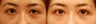 Droopy Eyelid or Ptosis Repair