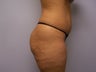 Brazilian Butt Lift