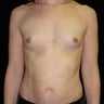 Breast Augmentation