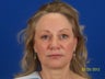 Facial Fat Grafting