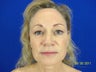 Facial Fat Grafting