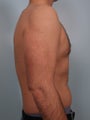 Male Breast Reduction- Gynecomastia