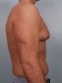 Male Breast Reduction- Gynecomastia