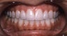 Smile Makeovers