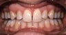 Smile Makeovers