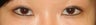 Bilateral Asian Eyelid Surgery