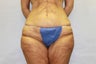 47 y.o with body lift