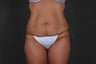 Tummy Tuck