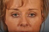 Hetter Peel on lower eyelids. 